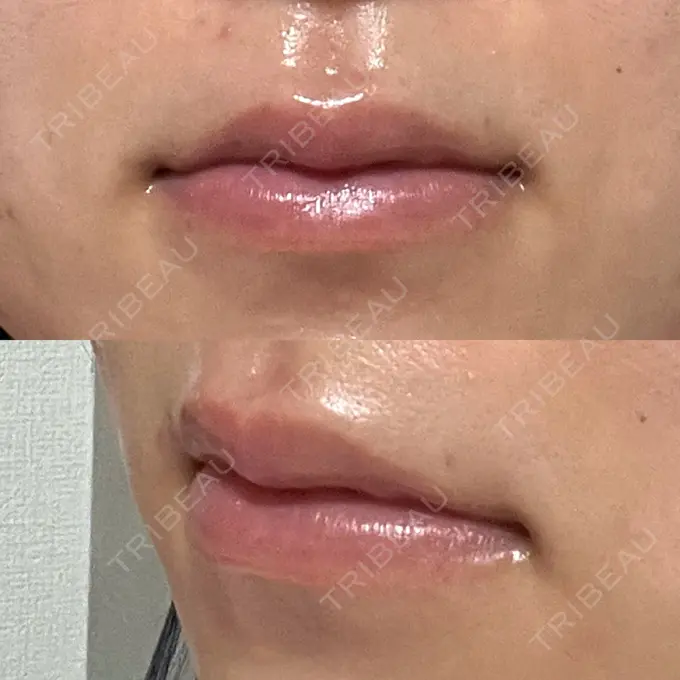 ヒアルロン酸注入（唇） 大美会クリニック 神戸院 DAY 11 メイン用