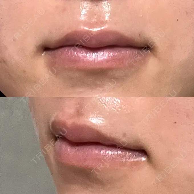 ヒアルロン酸注入（唇） 大美会クリニック 神戸院 DAY 12 メイン用