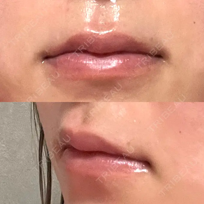 ヒアルロン酸注入（唇） 大美会クリニック 神戸院 AFTER メイン用