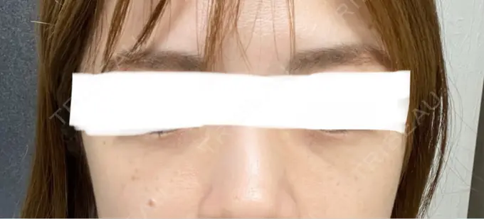 下まぶたの脂肪取り 川越TAクリニックアソシエ AFTER メイン用