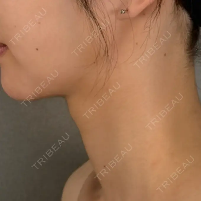 脂肪吸引（顔） / ジョールファット除去 / ボトックス（エラ・小顔） アリエル美容クリニック 大宮院 DAY 106 メイン用