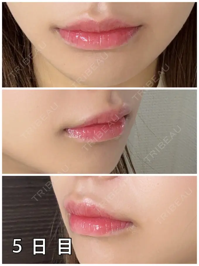 アートメイク（唇） 筋肉・美容クリニック DAY 5 メイン用