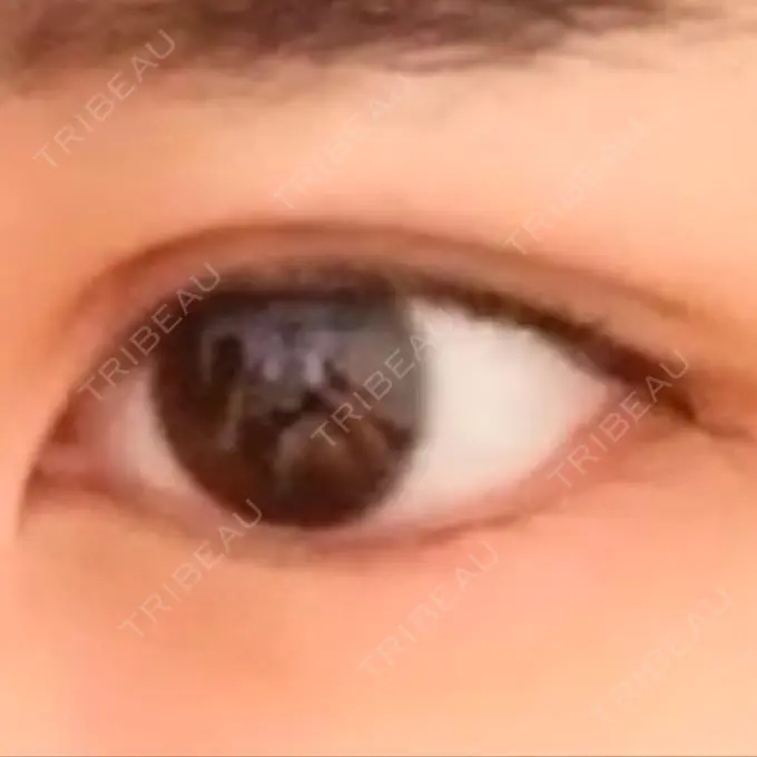 二重切開 よこはまエーブクリニック DAY 36 メイン用