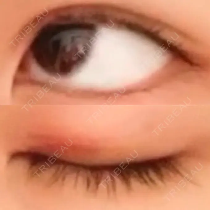 二重切開 よこはまエーブクリニック DAY 36 メイン用