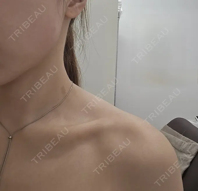 ボトックス（エラ・小顔） / ボトックス（肩） ヴァージンクリニック 福岡天神院 DAY 0 メイン用