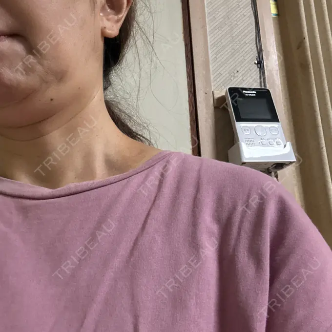 肌ヒアルロン酸注入（たるみ・シワ改善） / ヒアルロン酸注入（頬） / その他（口元） LIKI CLINIC KOBE DAY 4 メイン用