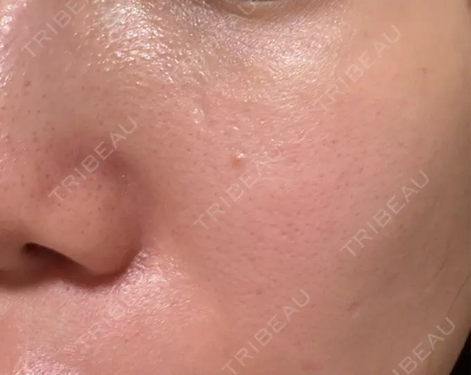 光治療（フォトフェイシャルなど） クレオビューティークリニック AFTER メイン用