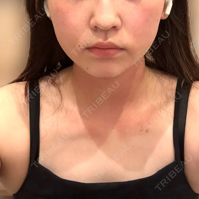 糸リフト / 脂肪吸引（顔） / ボトックス（あご） / ヒアルロン酸注入（あご） / ボトックス（エラ・小顔） / ヒアルロン酸注入（頬） / ヒアルロン酸注入（鼻翼基部） GRACIA clinic 【グラシアクリニック】 DAY 30 メイン用