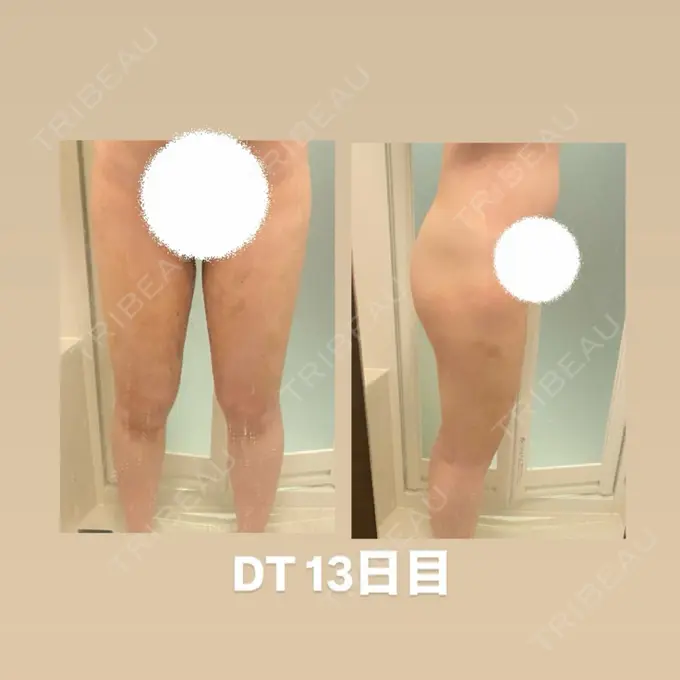 脂肪吸引（脚） 水の森美容クリニック 東京銀座院 DAY 13 メイン用