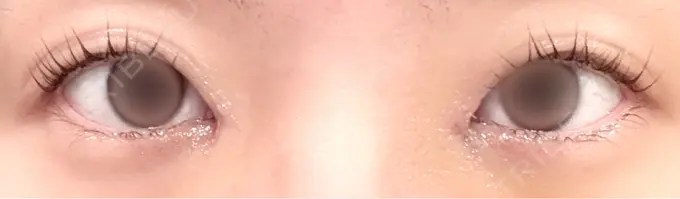 目頭切開 PRISM Beauty Clinic 町田院 DAY 4 メイン用