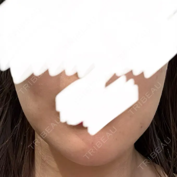 RF（高周波）たるみ治療 RIVER CLINIC（リバークリニック） DAY 2 メイン用