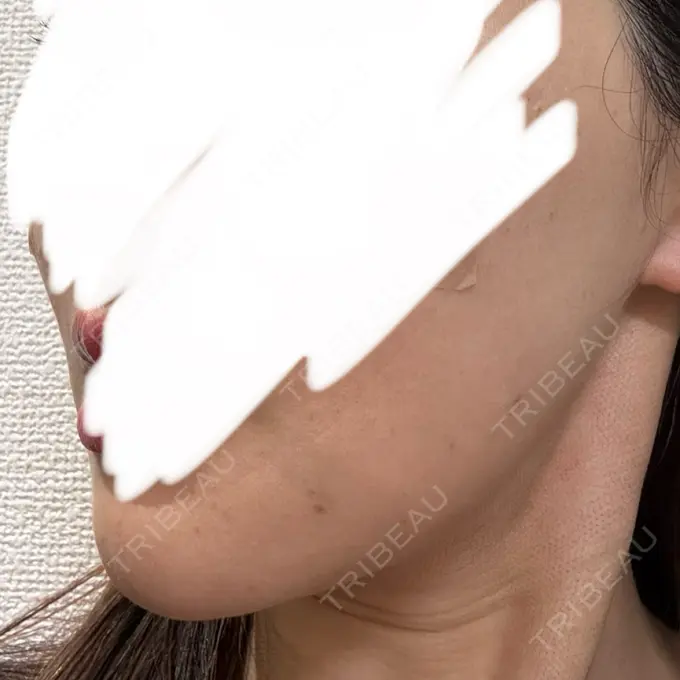 RF（高周波）たるみ治療 RIVER CLINIC（リバークリニック） DAY 2 メイン用