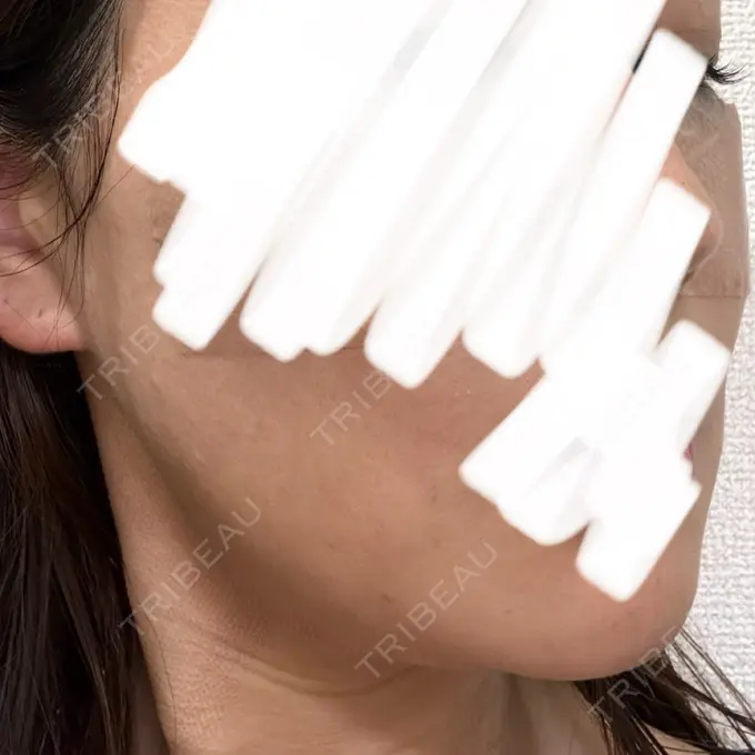 RF（高周波）たるみ治療 RIVER CLINIC（リバークリニック） DAY 2 メイン用