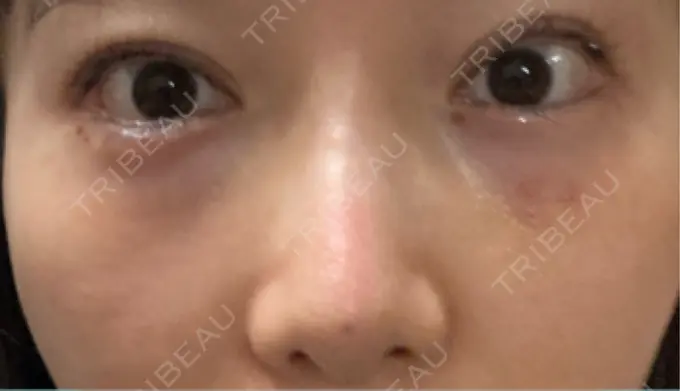 ヒアルロン酸溶解 EOL CLINIC【オルクリニック】 AFTER メイン用