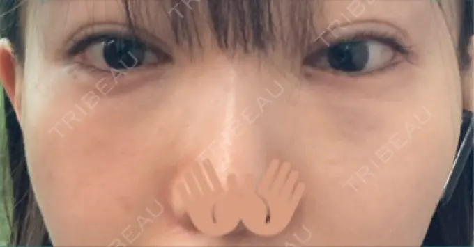 ヒアルロン酸溶解 EOL CLINIC【オルクリニック】 DAY 1 メイン用