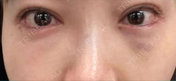 ヒアルロン酸溶解 EOL CLINIC【オルクリニック】 DAY 2 メイン用