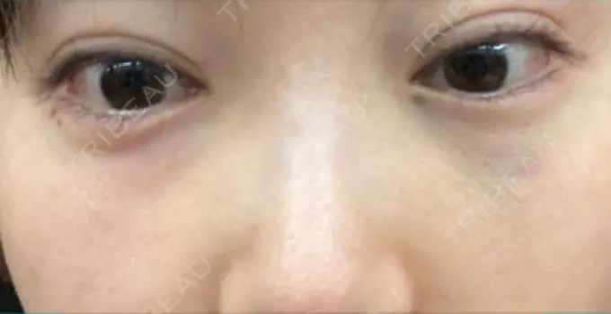 ヒアルロン酸溶解 EOL CLINIC【オルクリニック】 DAY 3 メイン用