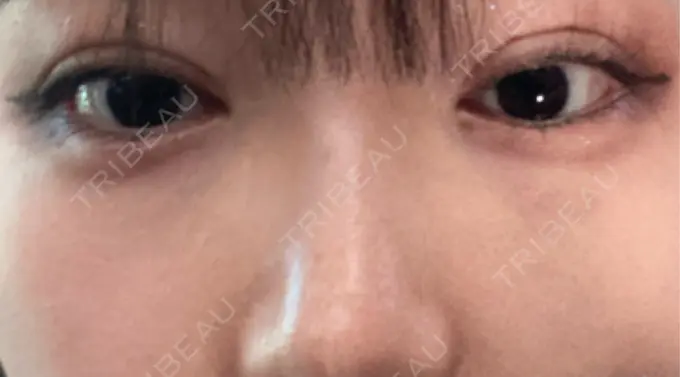 ヒアルロン酸溶解 EOL CLINIC【オルクリニック】 DAY 5 メイン用