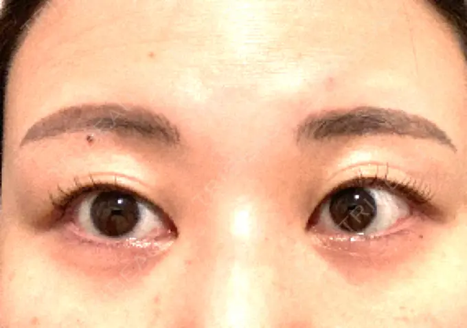 アートメイク（眉） ルーチェクリニック 銀座院 AFTER メイン用