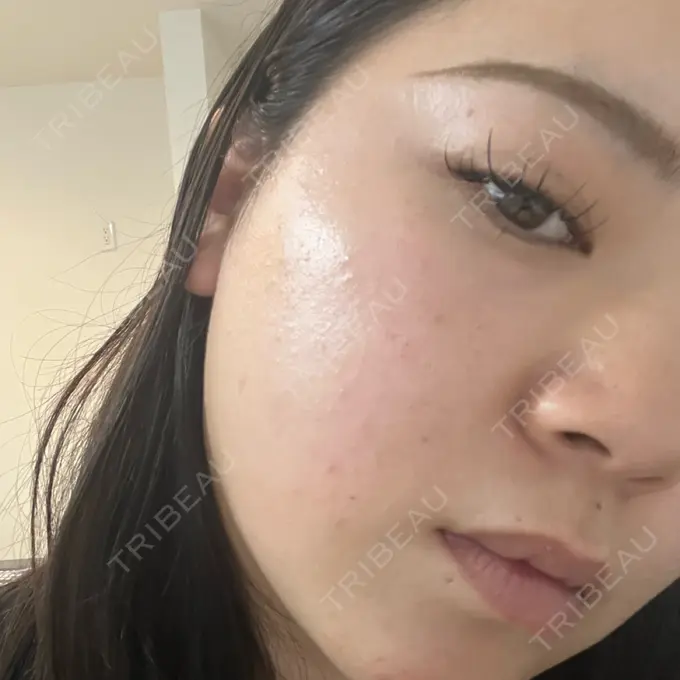 ルメッカ 東京美容外科 名古屋院 DAY 7 メイン用