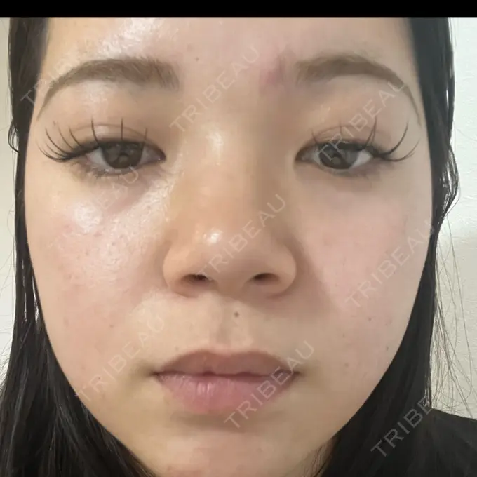 ルメッカ 東京美容外科 名古屋院 DAY 7 メイン用