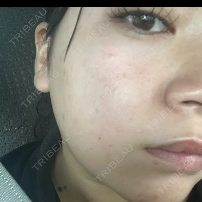 ルメッカ 東京美容外科 名古屋院 AFTER メイン用