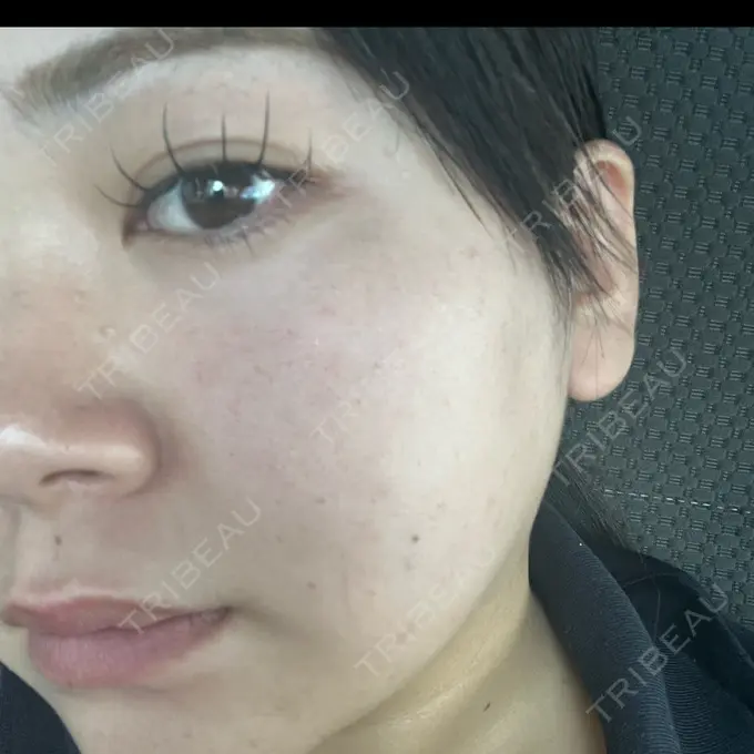 ルメッカ 東京美容外科 名古屋院 DAY 9 メイン用