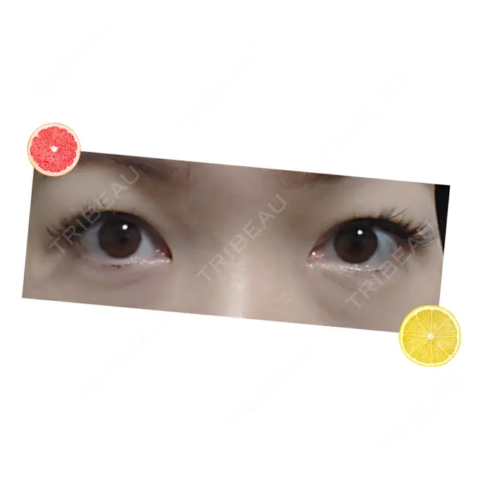 下まぶたたるみ取り 広島プルミエクリニック DAY 31 メイン用