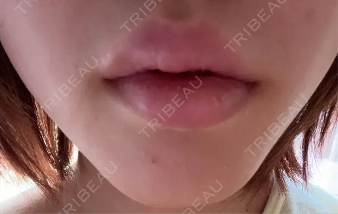 ボトックス（あご） ルラ美容クリニック 神戸院 DAY 1 メイン用