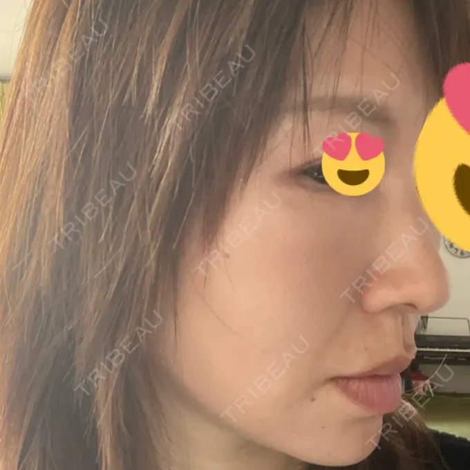 肌育注射（ジュベルックなど） / イオン導入 城本クリニック 横浜院 DAY 3 メイン用