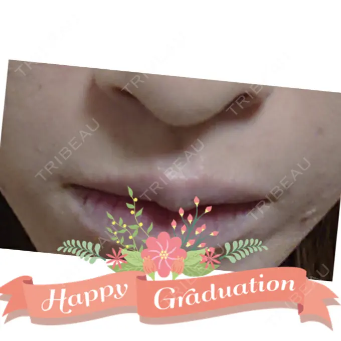 脂肪注入（肌） 広島プルミエクリニック DAY 31 メイン用