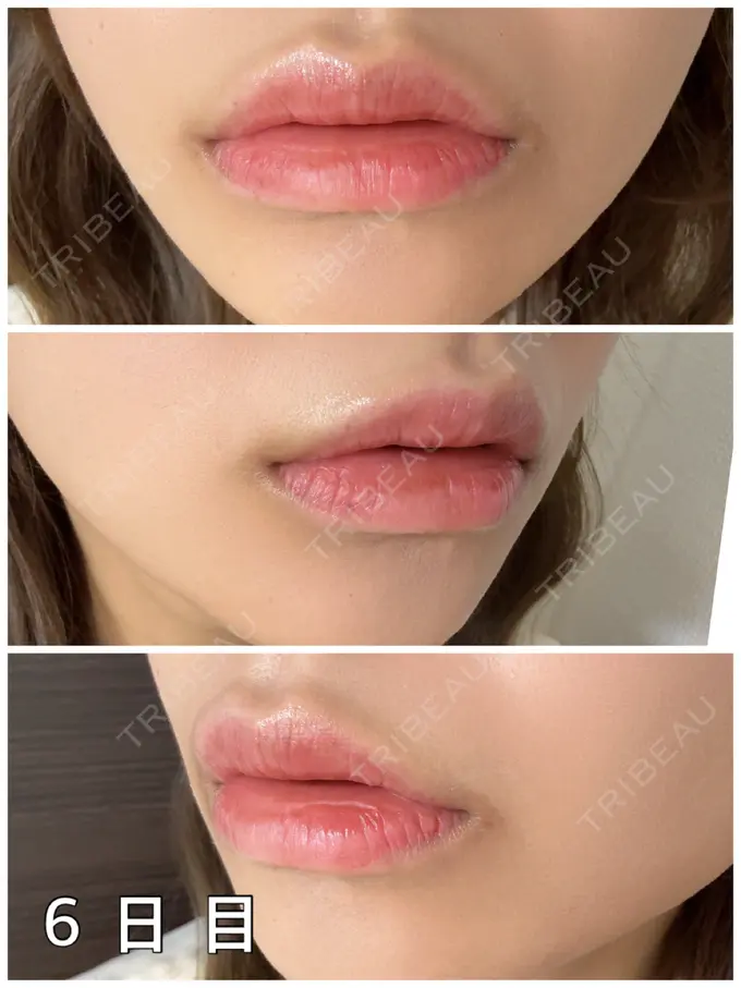 アートメイク（唇） 筋肉・美容クリニック DAY 6 メイン用