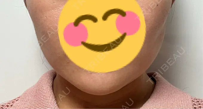 糸リフト / 脂肪吸引（顔） / 脂肪吸引注射（顔） ziz CLINIC DAY 6 メイン用