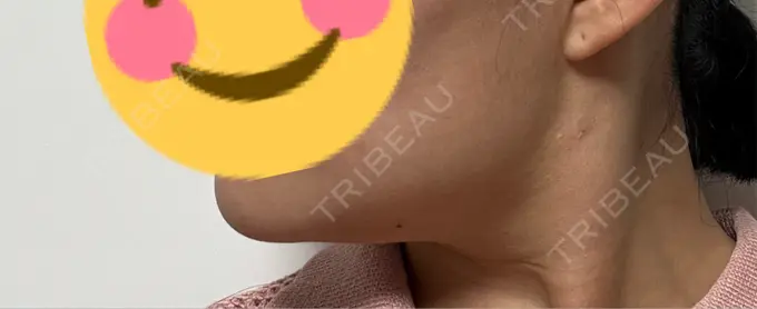 糸リフト / 脂肪吸引（顔） / 脂肪吸引注射（顔） ziz CLINIC DAY 6 メイン用