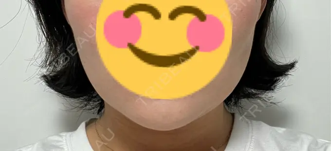 糸リフト / 脂肪吸引（顔） / 脂肪吸引注射（顔） ziz CLINIC DAY 12 メイン用