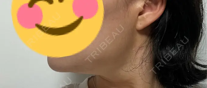 糸リフト / 脂肪吸引（顔） / 脂肪吸引注射（顔） ziz CLINIC DAY 12 メイン用