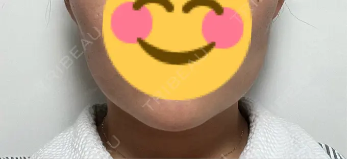 糸リフト / 脂肪吸引（顔） / 脂肪吸引注射（顔） ziz CLINIC DAY 20 メイン用