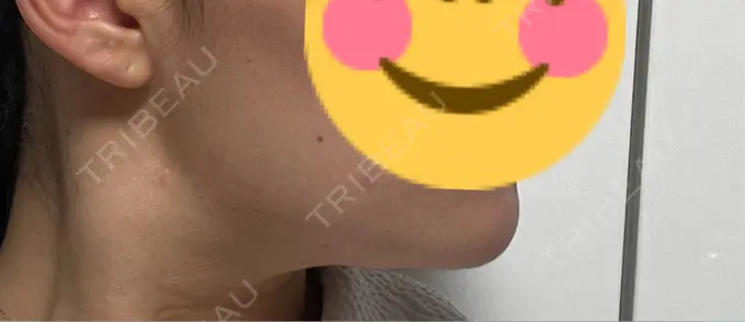 糸リフト / 脂肪吸引（顔） / 脂肪吸引注射（顔） ziz CLINIC DAY 20 メイン用