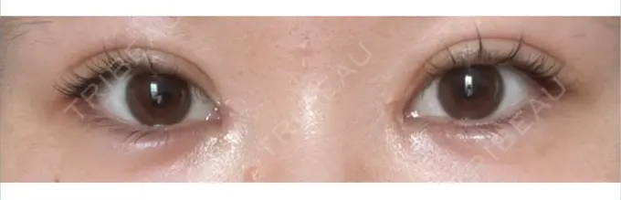 二重埋没 / 目頭切開 eクリニック 福岡院 AFTER メイン用