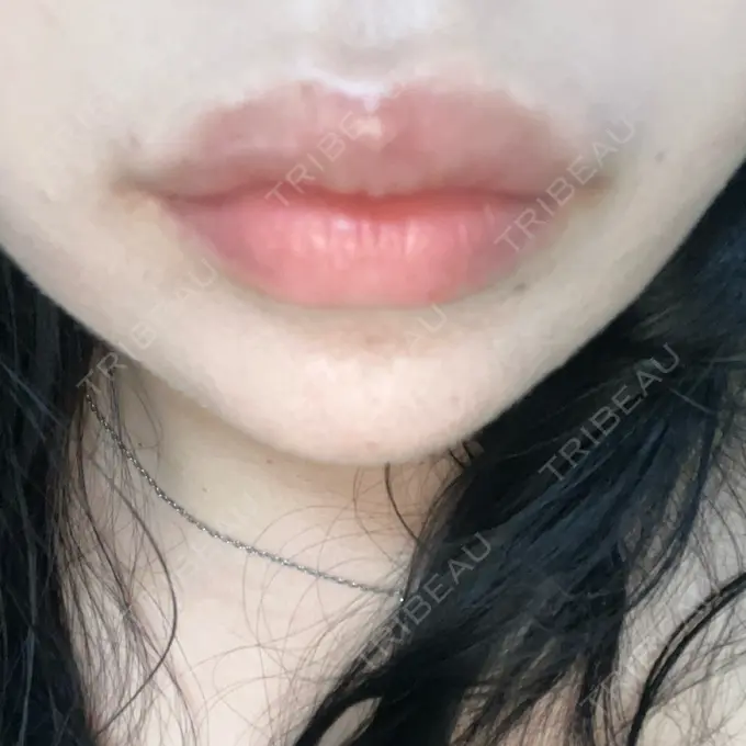 ボトックス（あご） / ヒアルロン酸注入（あご） / ボトックス（エラ・小顔） / ヒアルロン酸注入（唇） アリエル美容クリニック 横浜院 DAY 1 メイン用