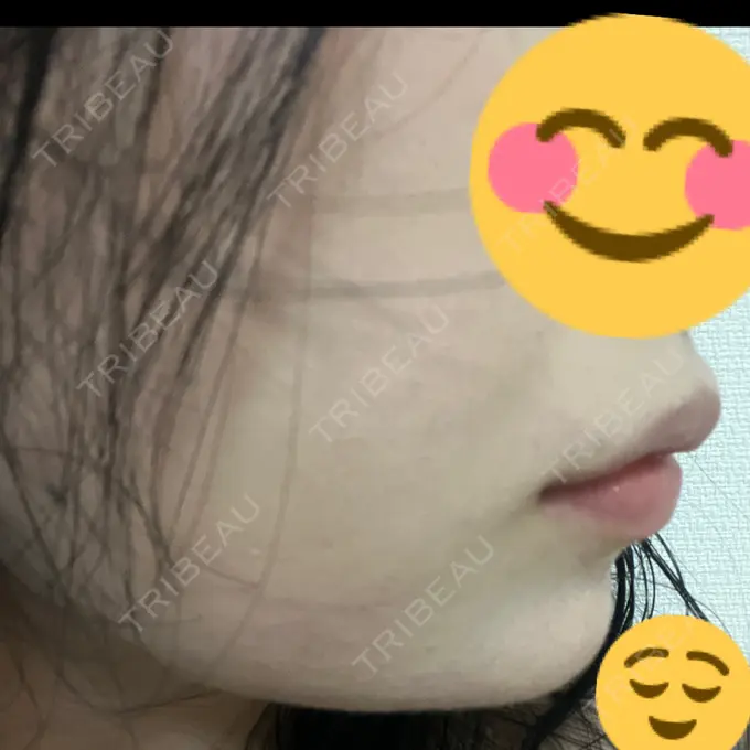 ボトックス（あご） / ヒアルロン酸注入（あご） / ボトックス（エラ・小顔） / ヒアルロン酸注入（唇） アリエル美容クリニック 横浜院 DAY 1 メイン用