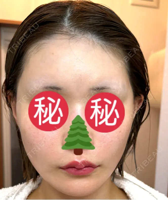 切開リフト GRACY TOKYO CLINIC【グレイシートウキョウクリニック】 DAY 6 メイン用