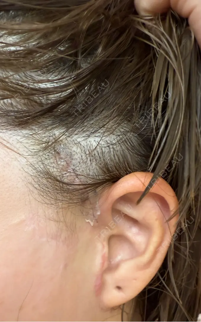 切開リフト GRACY TOKYO CLINIC【グレイシートウキョウクリニック】 DAY 6 メイン用