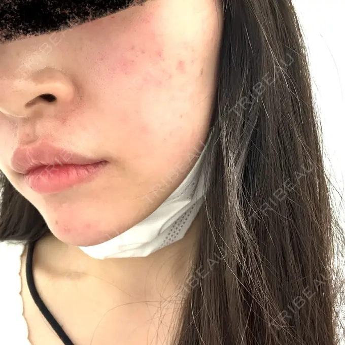 ピコレーザートーニング（美白・肝斑） / ピコフラクショナルレーザー（毛穴・ニキビ跡） 東京シルククリニック 東京神田院 AFTER メイン用