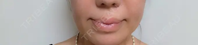 糸リフト アリエル美容クリニック 横浜院 AFTER メイン用