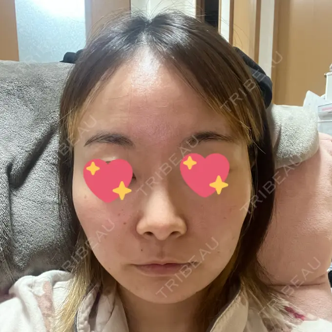 脂肪吸引（顔） ルラ美容クリニック 大宮院 / ルラスキンクリニック 大宮院 DAY 25 メイン用