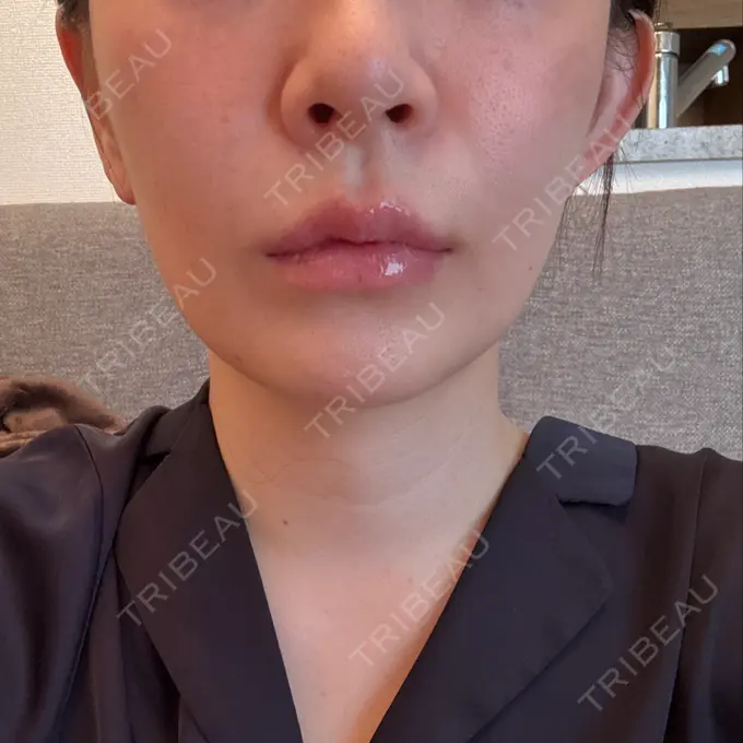 肌ヒアルロン酸注入（たるみ・シワ改善） / ヒアルロン酸注入（唇） 東京シルククリニック 東京神田院 DAY 6 メイン用