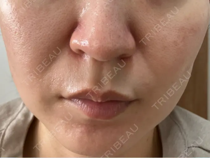 医療脱毛（顔） 渋谷美容外科クリニック 横浜院 DAY 2 メイン用