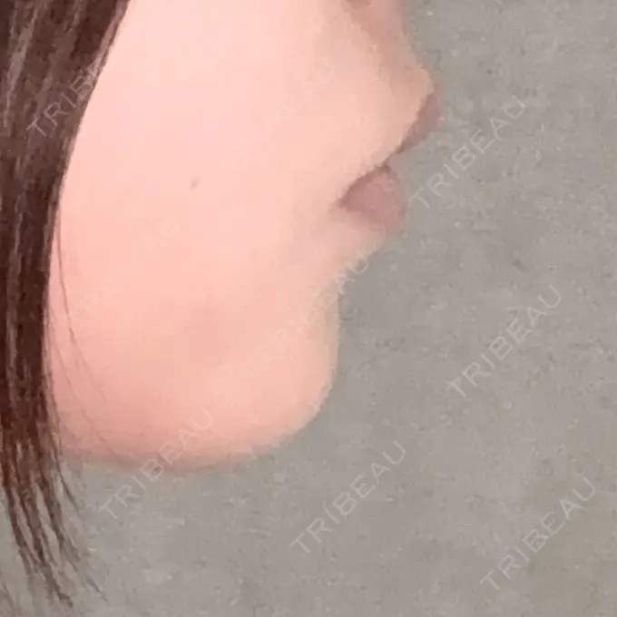 ヒアルロン酸注入（あご） TCB東京中央美容外科 大阪阪急梅田駅前院 AFTER メイン用