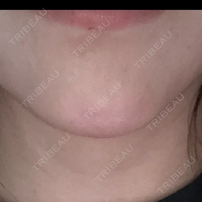 ヒアルロン酸注入（あご） TCB東京中央美容外科 大阪阪急梅田駅前院 DAY 9 メイン用